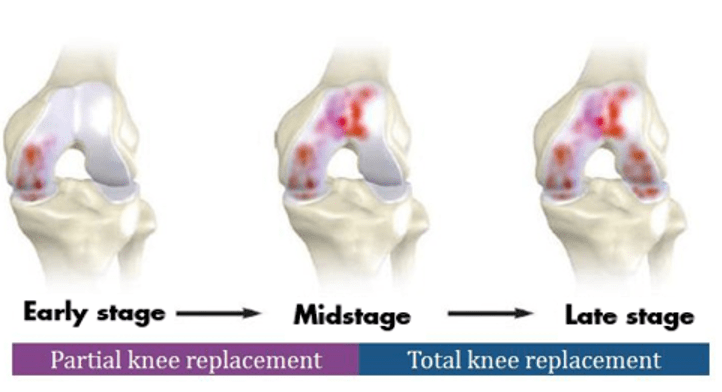 joint replacement diagram